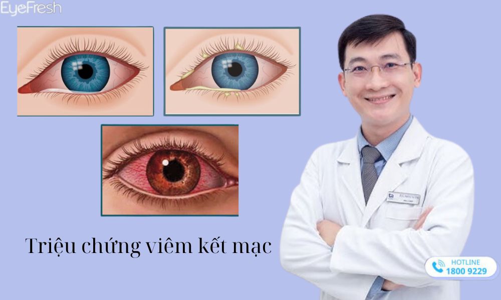 Triệu chứng khi bị viêm kết mạc